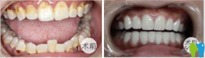 蒋医生牙齿瓷贴面联合修复前后对比效果