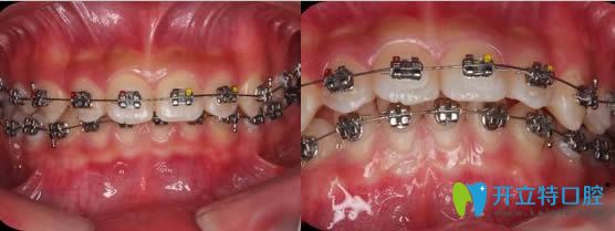 我在厦门康德佳口腔做牙齿矫正过程
