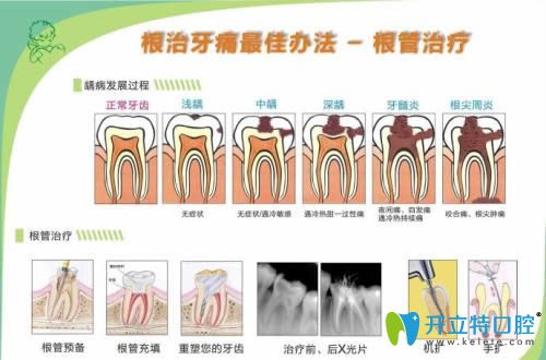 儿童乳牙根管治疗很重要