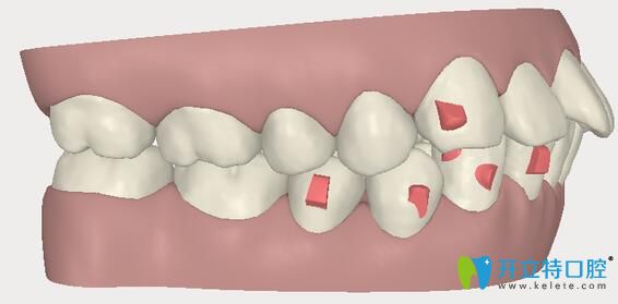 武汉欧燕口腔医生讲解:双颌前突戴牙套可以矫正吗？