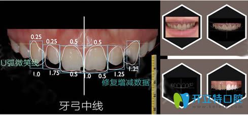 蒋睿医师解说全瓷牙修复的优势有哪些