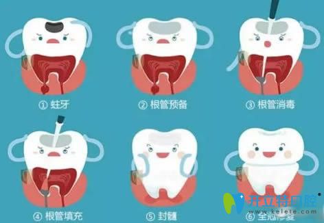 小孩乳牙根管治疗步骤图