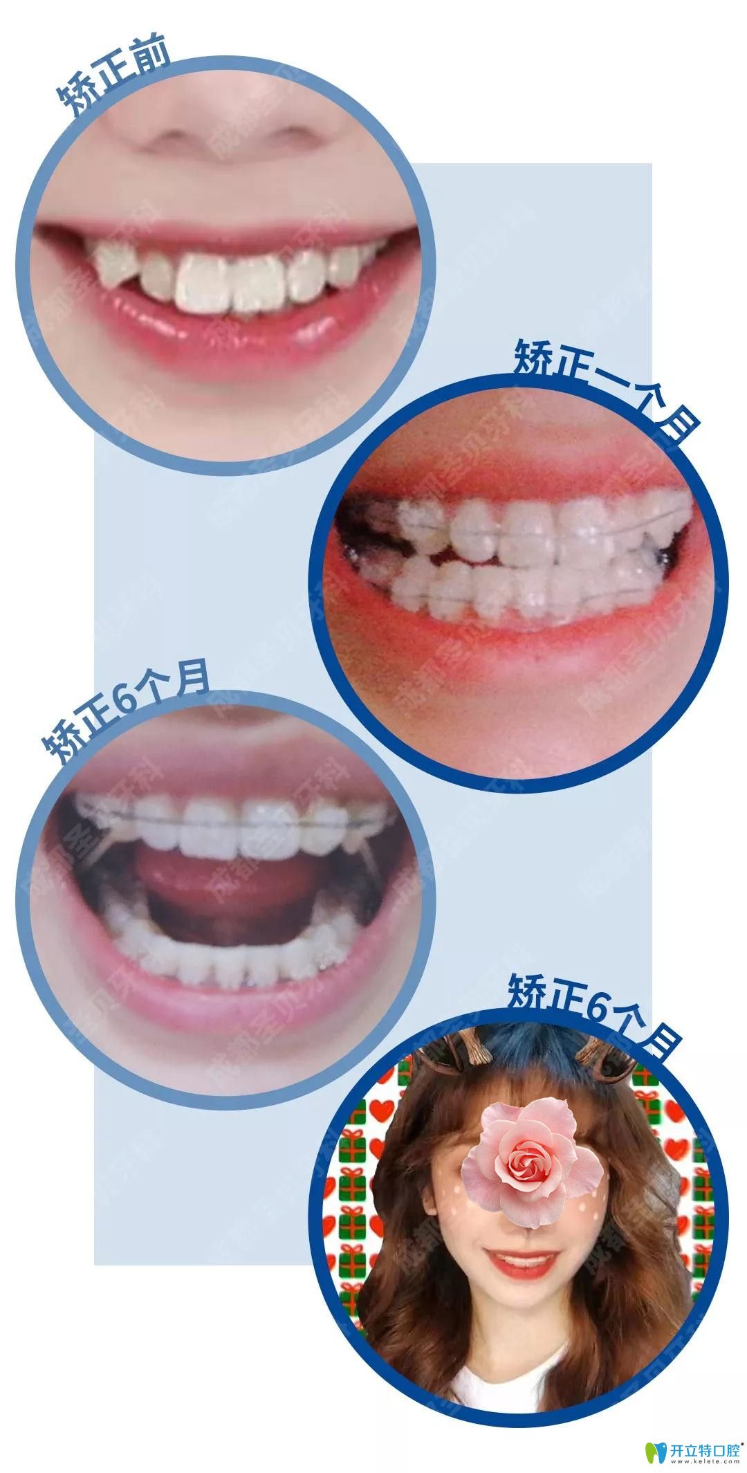 圣贝牙科带陶瓷牙套矫正牙齿变化过程