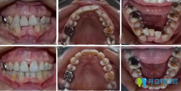 合肥维多利亚口腔牙齿矫正效果对比图