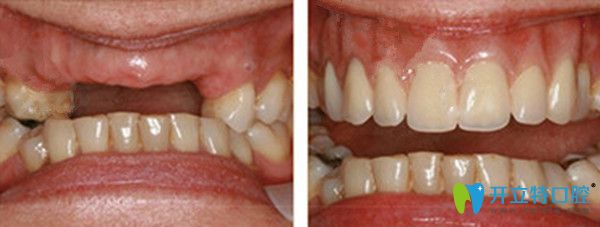 多颗牙缺失口腔种植前后对比图
