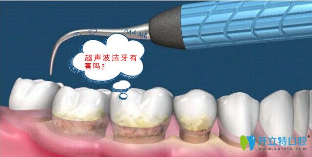 松桃鹏博口腔医生告诉你:超声波洁牙有害吗？