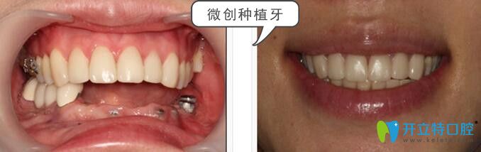 松桃鹏博口腔王鹏院长种植牙案例