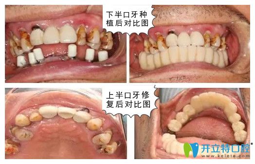深圳诺德齿科水激光种牙后对比图