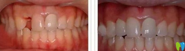 云齿口腔单颗牙即刻种植案例