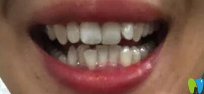 我在济南全好口腔做牙齿矫正前的照片