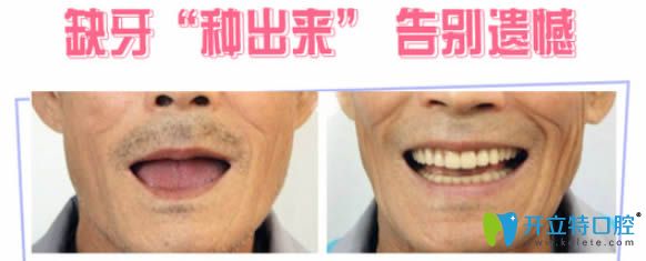 <!--<i data=20240703-sp></i>-->口腔科全口种植牙齿案例图
