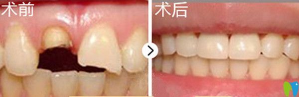 牙齿美容修复前后对比图 牙齿美容修复前后对比图
