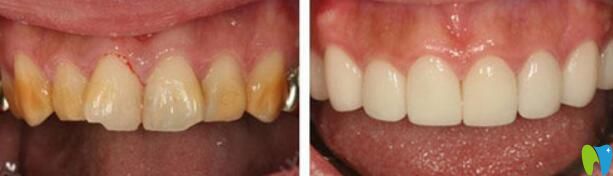杭州云齿口腔四环素牙冷光美白治疗前后效果对比