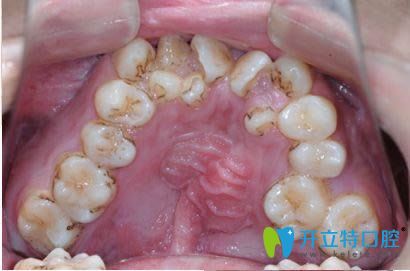 牙齿不齐容易引起牙周病及龋齿