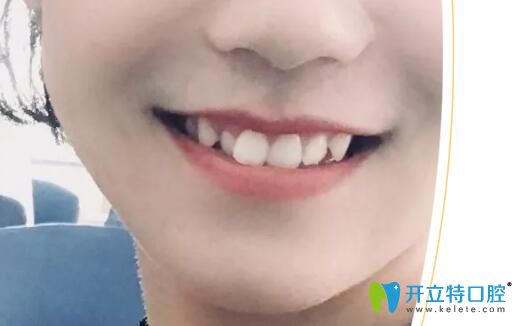26岁大龄女在邯郸连保强口腔矫正牙齿经验分享