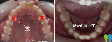 杭州全好口腔提供深覆盖牙齿矫正案例详情