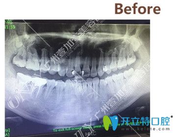 矫正前拍摄的CT 矫正前拍摄的CT