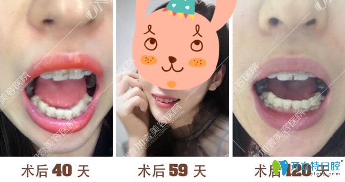 广州壹加壹矫正40-120天牙齿变化过程图 广州壹加壹矫正40-120天牙齿变化过程图