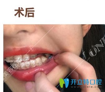 广州壹加壹初戴牙套 广州壹加壹初戴牙套