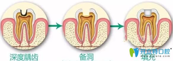 牙神经坏死治疗过程图