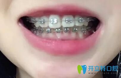 我在重庆团圆口腔做牙齿矫正12个月效果