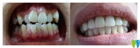 重庆团圆口腔隐形牙齿矫正前后对比效果