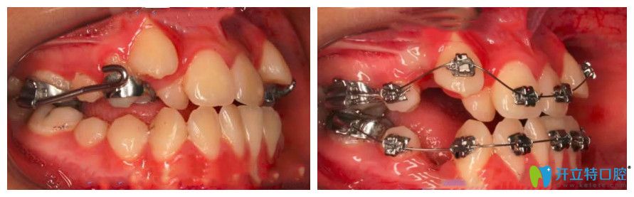 一期拔牙后矫正的过程图