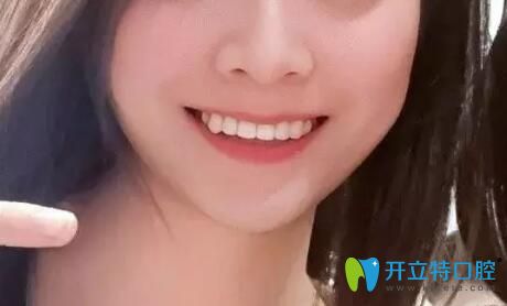 郑州德正口腔龅牙矫正后效果突 郑州德正口腔龅牙矫正后效果突