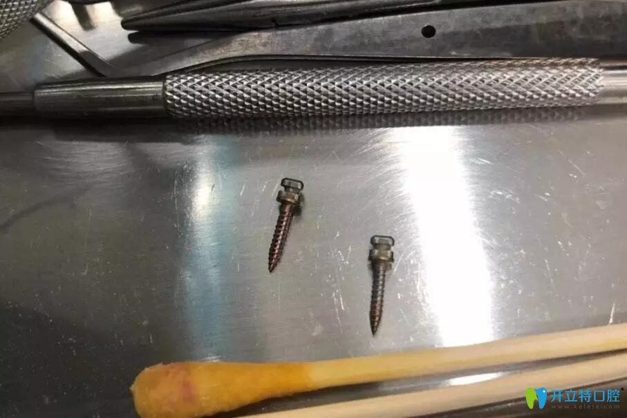 龅牙矫正中使用到的支抗钉 龅牙矫正中使用到的支抗钉