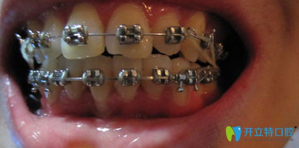 牙齿开合的治疗方法