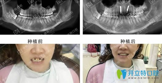 德韩口腔种植牙效果前后对比图