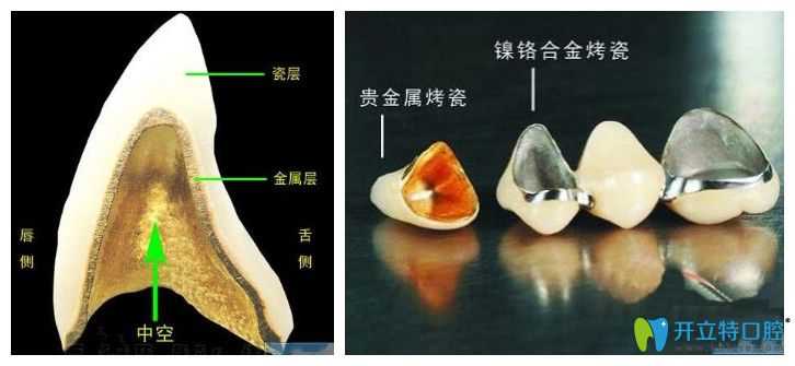 注意,烤瓷牙变成这样就要及时拆除啦！