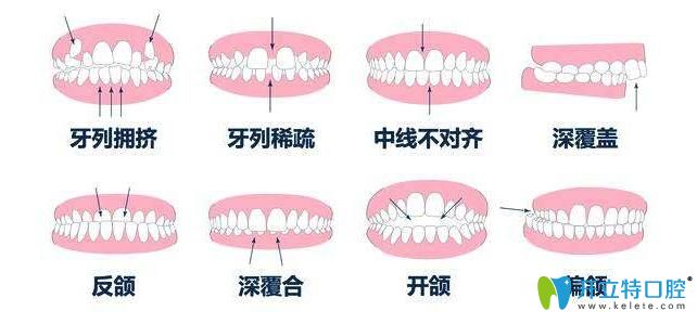个人的牙齿情况也影响矫正的价格