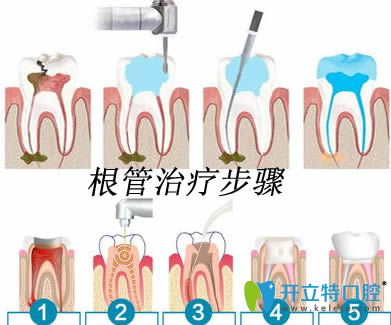 厦门康尔口腔李凯霞医生讲解根骨治疗的牙齿为什么需要戴牙冠