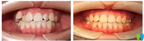 数字化隐形矫正案例