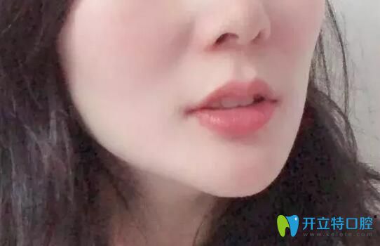 德韩口腔下牙套后照片