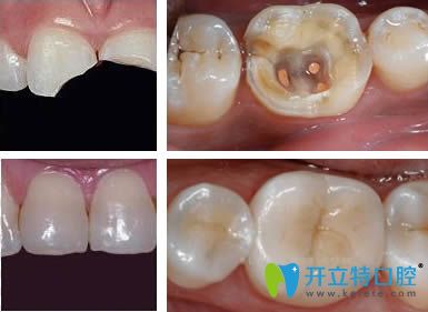 牙齿缺损的修复效果对比图