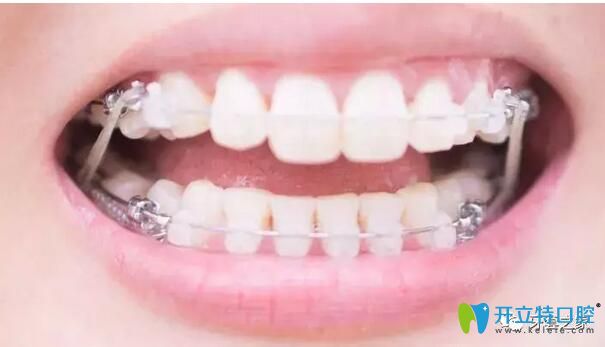 牙齿正畸过程开始关闭牙齿缝隙