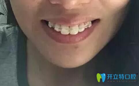 南昌德韩口腔带金属牙套第2天