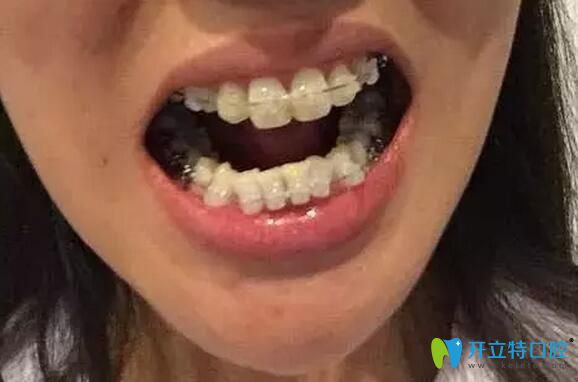 南昌德韩口腔龅牙矫正中