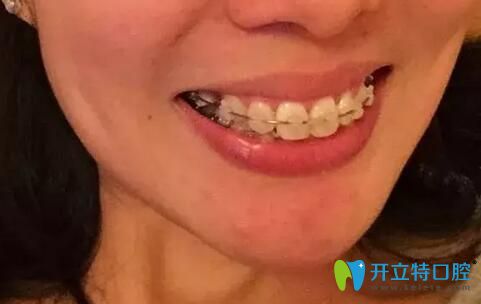 拆掉垫高的树脂后，发现咬合全错位了