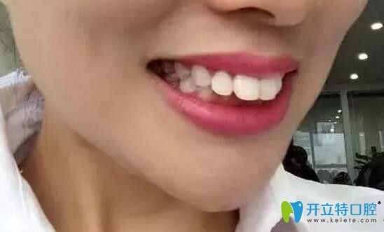 矫正前，上排门牙外凸