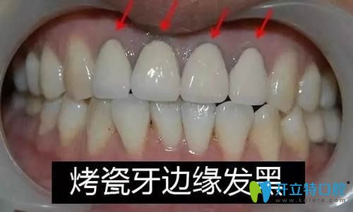 烤瓷牙套边缘发黑症状图