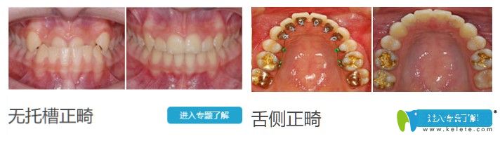 昆明德韩口腔青少年地包天矫正前后对比照 昆明德韩口腔青少年地包天矫正前后对比照