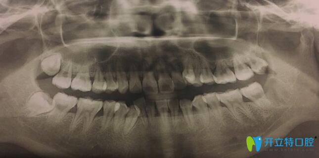 牙根短适不适合戴牙套？真人体验后谈牙根短做正畸的后果