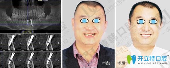 昆明德韩全口即刻种植牙案例效果图 昆明德韩全口即刻种植牙案例效果图