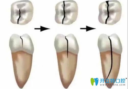 牙隐裂的发展过程图