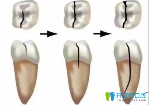牙隐裂的发展过程图 牙隐裂的发展过程图