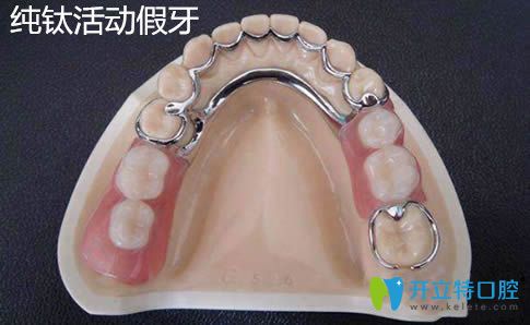 谈活动义齿佼佼者：纯钛活动假牙价格及有没有副作用