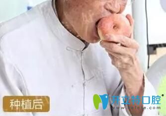 80岁老人全口种植亲身经历